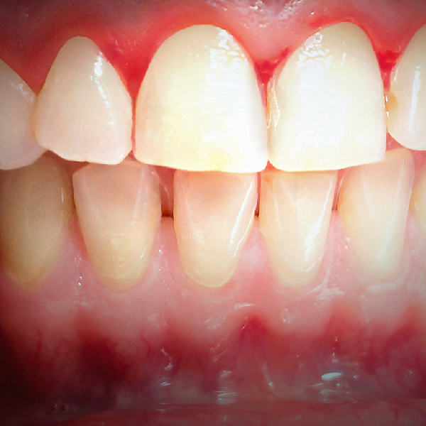 Implant Dentistery In Pune